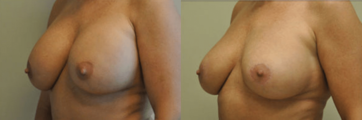 Randy Rudderman MD Plastic Surgery & Medical Spa breast augmentation result — Atlanta, GA