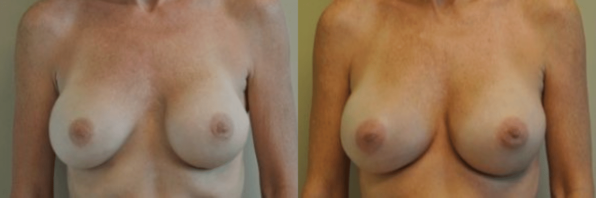 Randy Rudderman MD Plastic Surgery & Medical Spa breast augmentation result — Atlanta, GA
