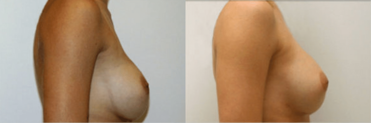 Randy Rudderman MD Plastic Surgery & Medical Spa breast augmentation result — Atlanta, GA