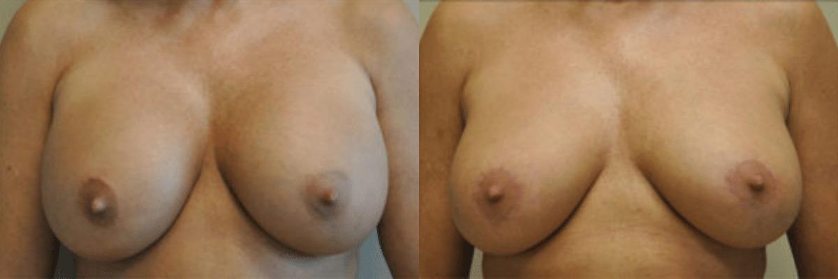 Randy Rudderman MD Plastic Surgery & Medical Spa breast augmentation result — Atlanta, GA