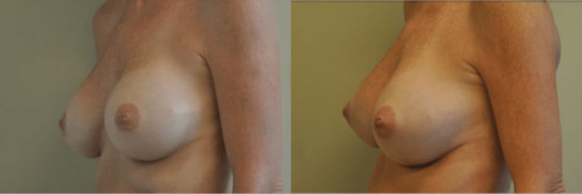 Randy Rudderman MD Plastic Surgery & Medical Spa breast augmentation result — Atlanta, GA