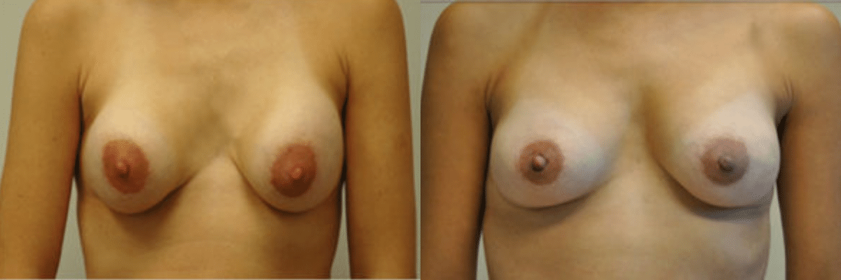 Randy Rudderman MD Plastic Surgery & Medical Spa breast augmentation result — Atlanta, GA