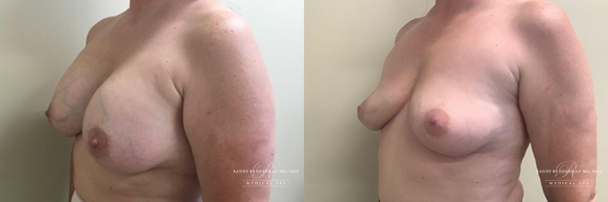 Randy Rudderman MD Plastic Surgery & Medical Spa breast augmentation result — Atlanta, GA