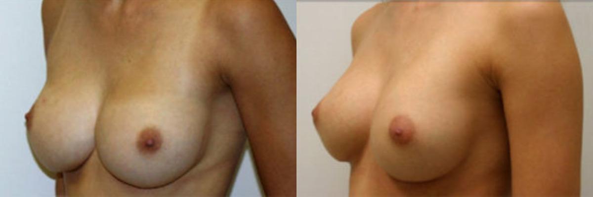 Randy Rudderman MD Plastic Surgery & Medical Spa breast augmentation result — Atlanta, GA