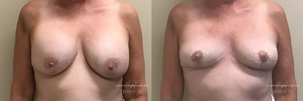 Randy Rudderman MD Plastic Surgery & Medical Spa breast augmentation result — Atlanta, GA