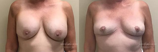 Breast Augmentation result at Randy Rudderman MD Plastic Surgery & Medical Spa in Atlanta, GA