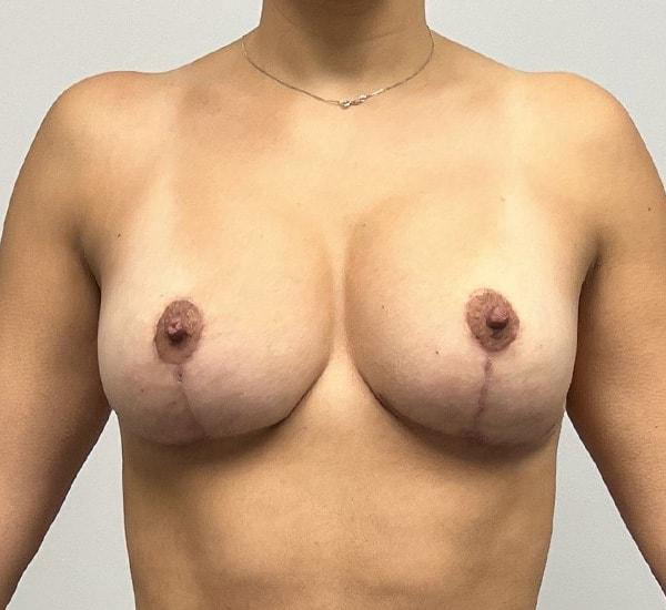 Lind Plastic Surgery & Med Spa breast lift after — Spring, TX