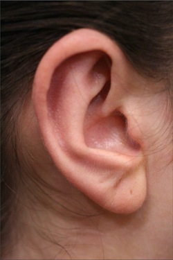 Dr. Richard W. Maack, MD, FACS: Synergi Facial Surgery otoplasty after — Chesterfield, MO