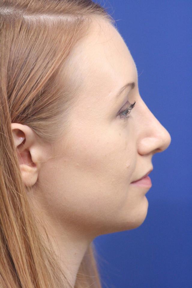Ethnic Rhinoplasty after at Dr. Richard W. Maack, MD, FACS: Synergi Facial Surgery in Chesterfield, MO
