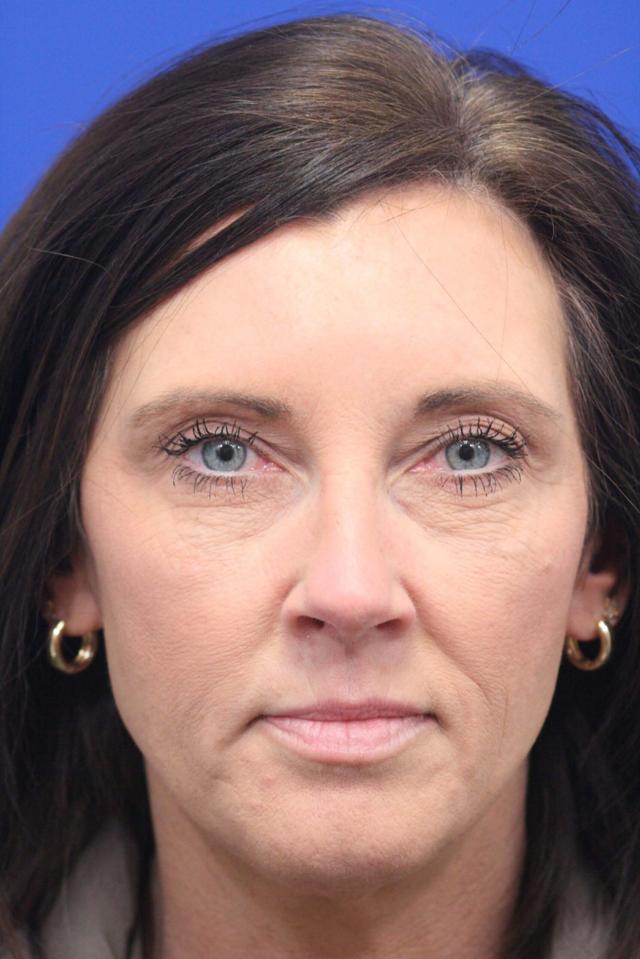 Blepharoplasty after at Dr. Richard W. Maack, MD, FACS: Synergi Facial Surgery in Chesterfield, MO