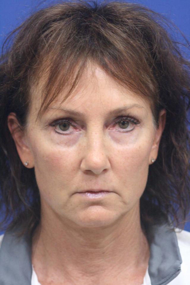 Mini Facelift before at Dr. Richard W. Maack, MD, FACS: Synergi Facial Surgery in Chesterfield, MO