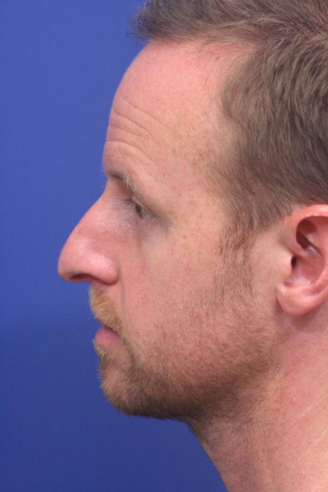 Ethnic Rhinoplasty before at Dr. Richard W. Maack, MD, FACS: Synergi Facial Surgery in Chesterfield, MO