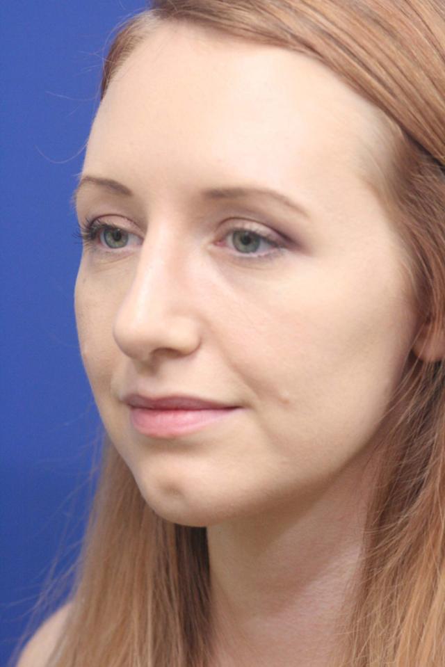 Ethnic Rhinoplasty after at Dr. Richard W. Maack, MD, FACS: Synergi Facial Surgery in Chesterfield, MO