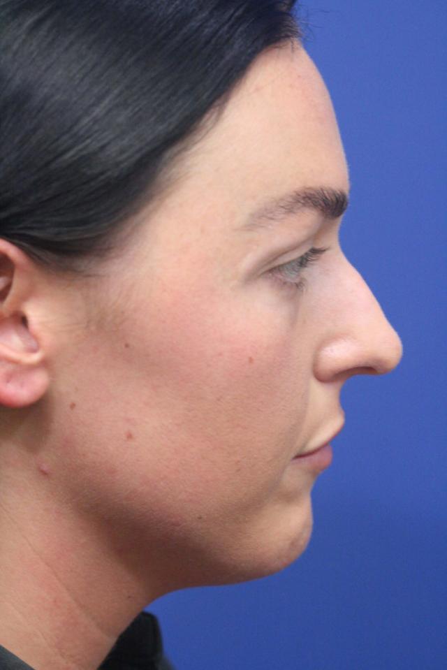 Ethnic Rhinoplasty before at Dr. Richard W. Maack, MD, FACS: Synergi Facial Surgery in Chesterfield, MO