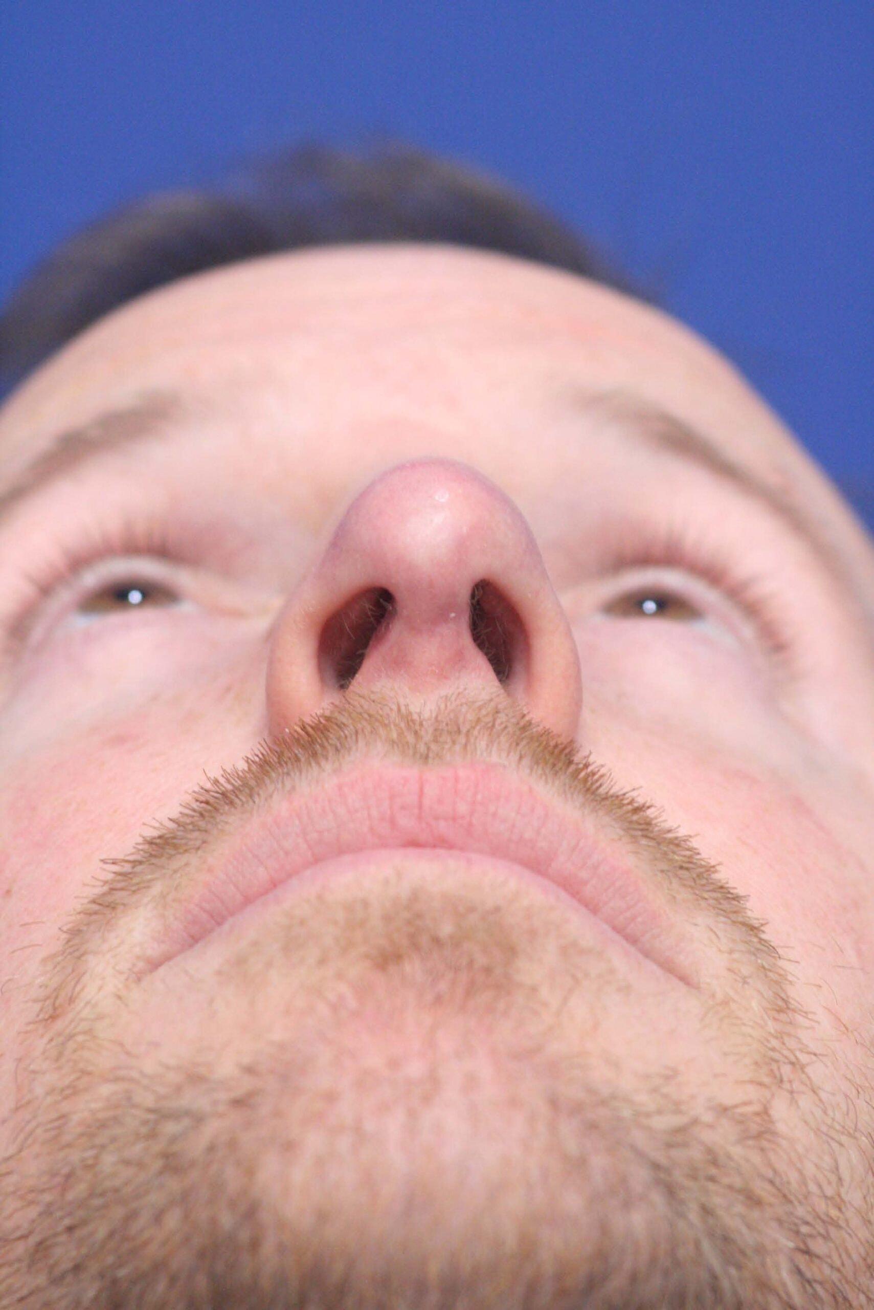 Dr. Richard W. Maack, MD, FACS: Synergi Facial Surgery rhinoplasty after — Chesterfield, MO