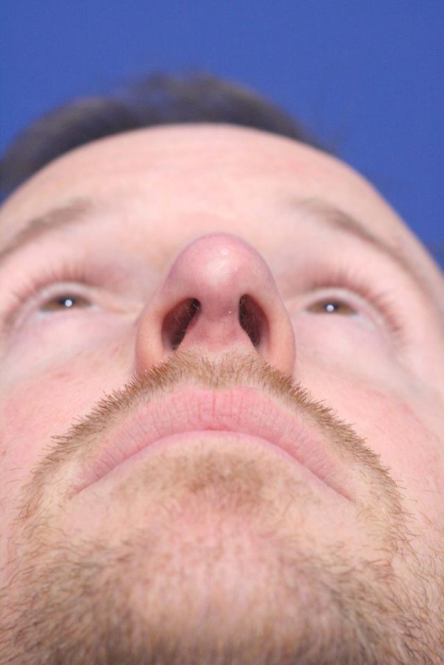 Ethnic Rhinoplasty after at Dr. Richard W. Maack, MD, FACS: Synergi Facial Surgery in Chesterfield, MO