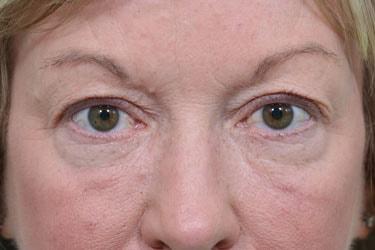 Blepharoplasty before at Dr. Richard W. Maack, MD, FACS: Synergi Facial Surgery in Chesterfield, MO