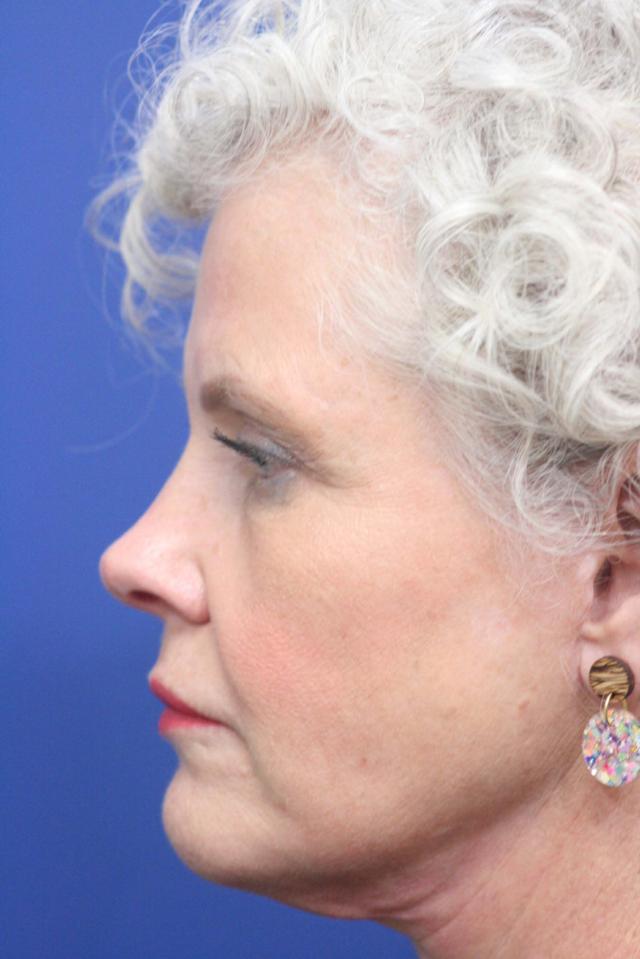 Brow Lift before at Dr. Richard W. Maack, MD, FACS: Synergi Facial Surgery in Chesterfield, MO