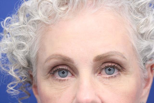 Brow Lift after at Dr. Richard W. Maack, MD, FACS: Synergi Facial Surgery in Chesterfield, MO
