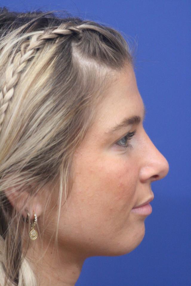 Ethnic Rhinoplasty after at Dr. Richard W. Maack, MD, FACS: Synergi Facial Surgery in Chesterfield, MO