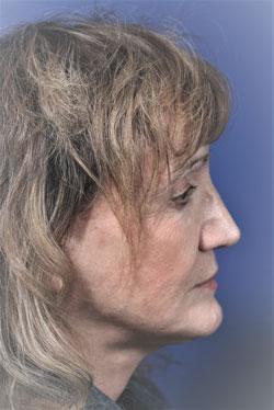 Deep Plane Facelift after at Dr. Richard W. Maack, MD, FACS: Synergi Facial Surgery in Chesterfield, MO