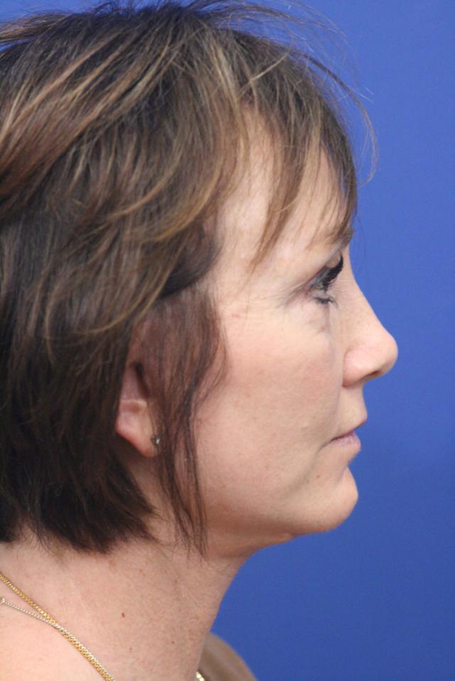 Mini Facelift after at Dr. Richard W. Maack, MD, FACS: Synergi Facial Surgery in Chesterfield, MO