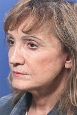 Deep Plane Facelift after at Dr. Richard W. Maack, MD, FACS: Synergi Facial Surgery in Chesterfield, MO
