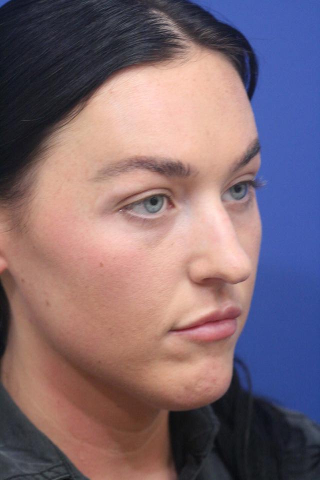Ethnic Rhinoplasty before at Dr. Richard W. Maack, MD, FACS: Synergi Facial Surgery in Chesterfield, MO