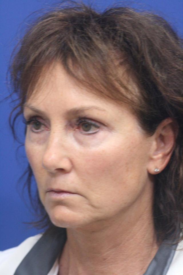 Mini Facelift before at Dr. Richard W. Maack, MD, FACS: Synergi Facial Surgery in Chesterfield, MO