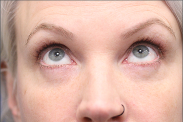 Dr. Richard W. Maack, MD, FACS: Synergi Facial Surgery after — Chesterfield, MO