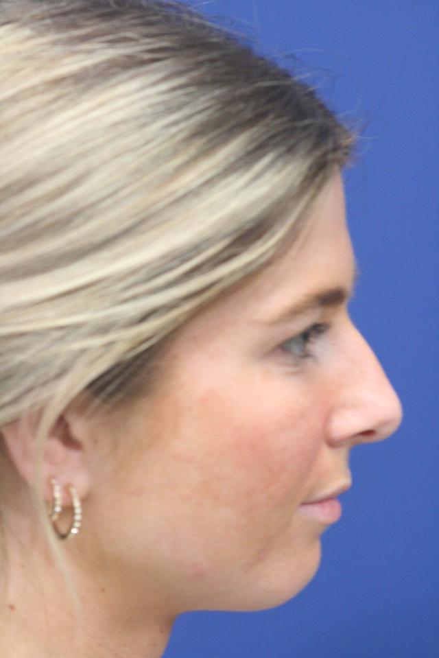 Ethnic Rhinoplasty before at Dr. Richard W. Maack, MD, FACS: Synergi Facial Surgery in Chesterfield, MO