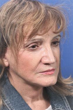 Dr. Richard W. Maack, MD, FACS: Synergi Facial Surgery facelift after — Chesterfield, MO
