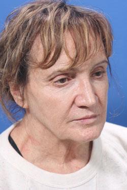 Deep Plane Facelift before at Dr. Richard W. Maack, MD, FACS: Synergi Facial Surgery in Chesterfield, MO