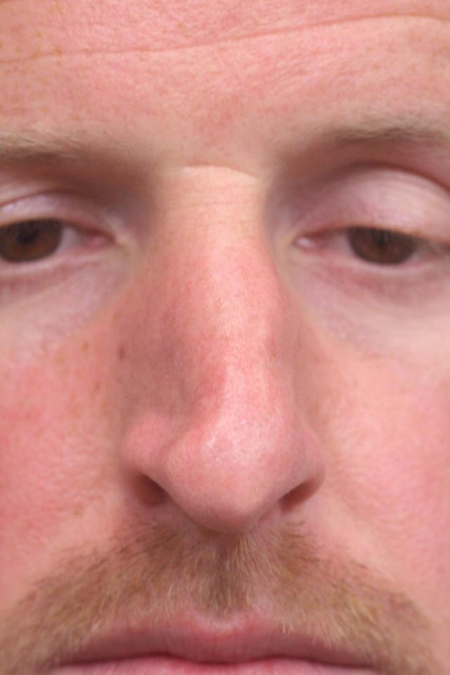 Ethnic Rhinoplasty before at Dr. Richard W. Maack, MD, FACS: Synergi Facial Surgery in Chesterfield, MO