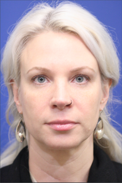 Dr. Richard W. Maack, MD, FACS: Synergi Facial Surgery after — Chesterfield, MO