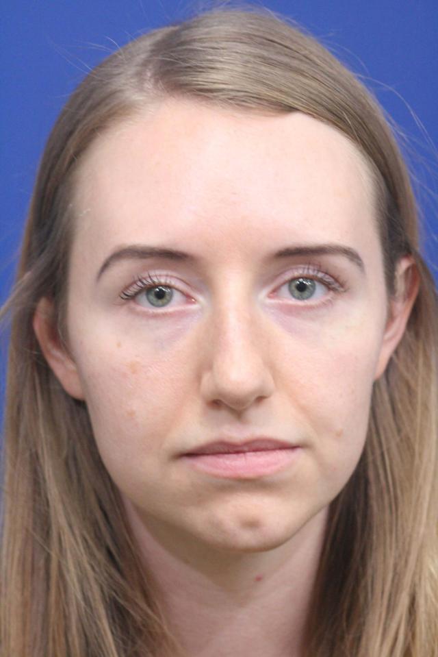 Ethnic Rhinoplasty before at Dr. Richard W. Maack, MD, FACS: Synergi Facial Surgery in Chesterfield, MO