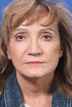 Deep Plane Facelift after at Dr. Richard W. Maack, MD, FACS: Synergi Facial Surgery in Chesterfield, MO