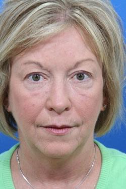 Blepharoplasty before at Dr. Richard W. Maack, MD, FACS: Synergi Facial Surgery in Chesterfield, MO