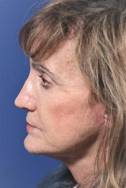 Deep Plane Facelift after at Dr. Richard W. Maack, MD, FACS: Synergi Facial Surgery in Chesterfield, MO