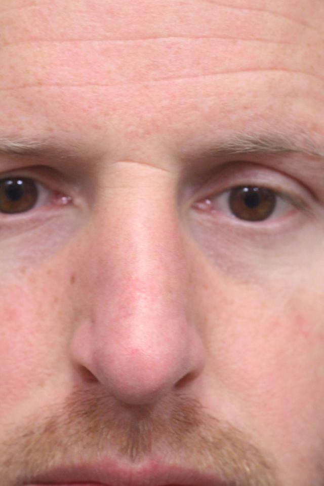 Ethnic Rhinoplasty after at Dr. Richard W. Maack, MD, FACS: Synergi Facial Surgery in Chesterfield, MO