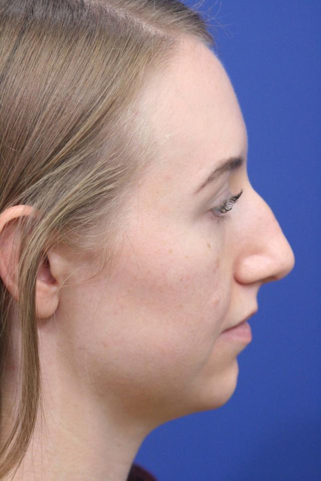 Ethnic Rhinoplasty before at Dr. Richard W. Maack, MD, FACS: Synergi Facial Surgery in Chesterfield, MO