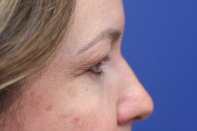 Blepharoplasty before at Dr. Richard W. Maack, MD, FACS: Synergi Facial Surgery in Chesterfield, MO