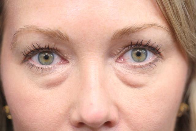 Blepharoplasty before at Dr. Richard W. Maack, MD, FACS: Synergi Facial Surgery in Chesterfield, MO