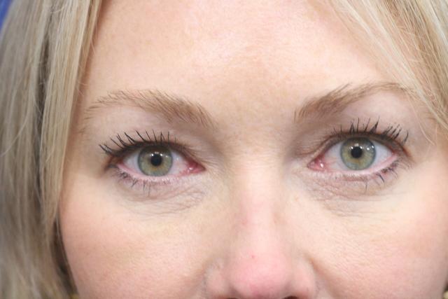 Blepharoplasty after at Dr. Richard W. Maack, MD, FACS: Synergi Facial Surgery in Chesterfield, MO