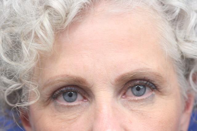 Brow Lift before at Dr. Richard W. Maack, MD, FACS: Synergi Facial Surgery in Chesterfield, MO
