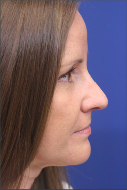 Dr. Richard W. Maack, MD, FACS: Synergi Facial Surgery rhinoplasty after — Chesterfield, MO