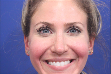 Dr. Richard W. Maack, MD, FACS: Synergi Facial Surgery otoplasty after — Chesterfield, MO
