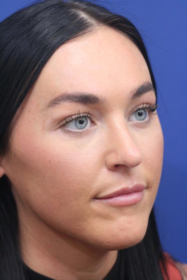 Ethnic Rhinoplasty after at Dr. Richard W. Maack, MD, FACS: Synergi Facial Surgery in Chesterfield, MO