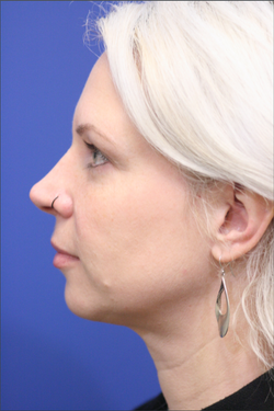 Dr. Richard W. Maack, MD, FACS: Synergi Facial Surgery liposuction after — Chesterfield, MO