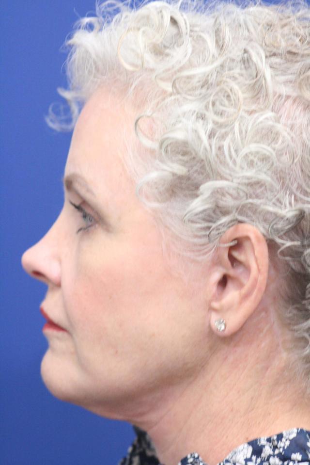 Brow Lift after at Dr. Richard W. Maack, MD, FACS: Synergi Facial Surgery in Chesterfield, MO